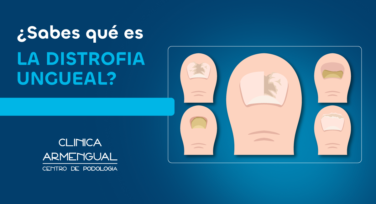 distrofia ungueal