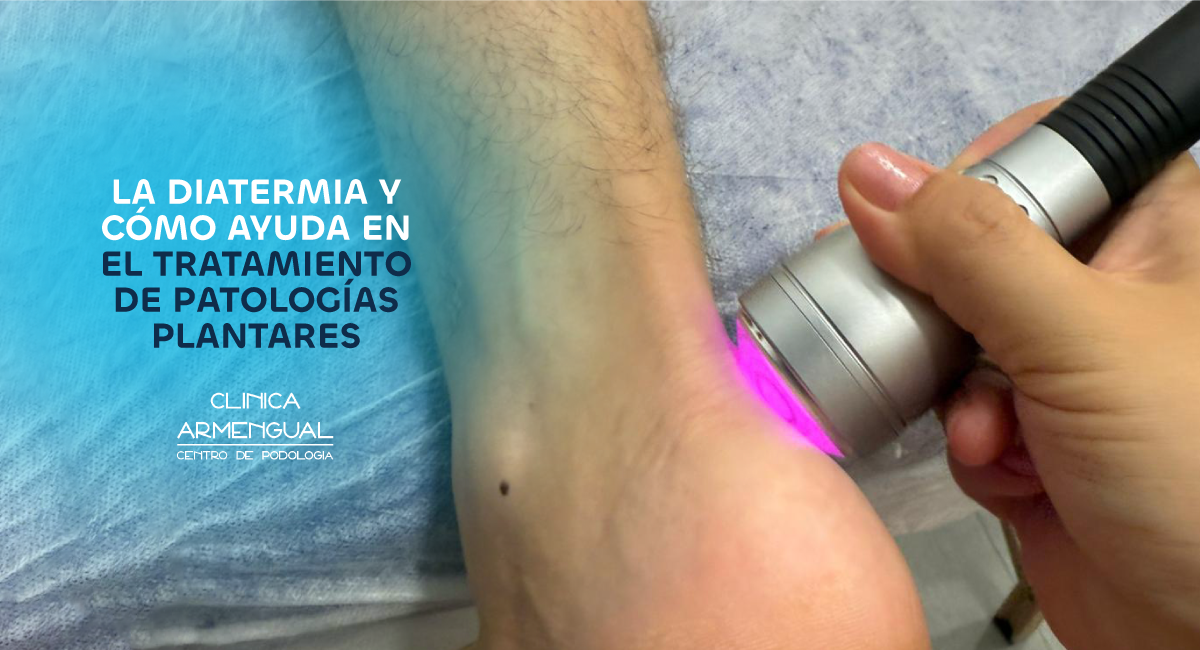 Diatermia: tratmiento